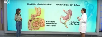 Segunda etapa de la cirugía bariátrica: el proceso quirúrgico