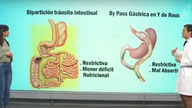 Segunda etapa de la cirugía bariátrica: el proceso quirúrgico