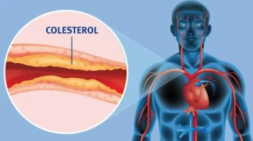 Lanzaron un medicamento para bajar el colesterol hecho en Argentina