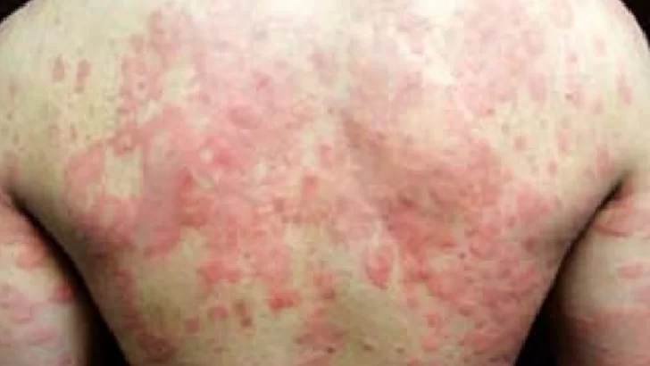 Más de 100.000 argentinos padecen urticaria crónica: una enfermedad que afecta la calidad de vida