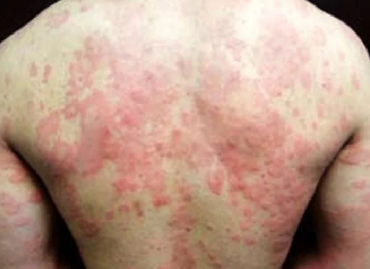 Más de 100.000 argentinos padecen urticaria crónica: una enfermedad que afecta la calidad de vida